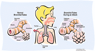 Asthma in the body graphic