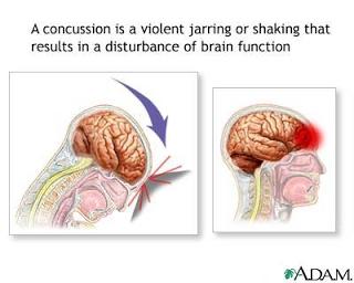 Concussions Graphic